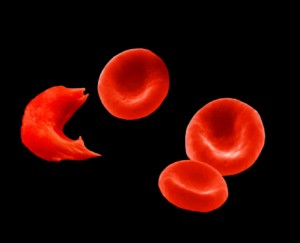 Sickle-Cell